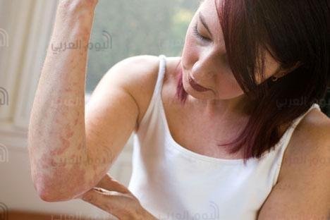 اسباب الاصابة بــ إكزيما اليدين وكيفية علاجها