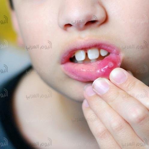 تقرحات الفم